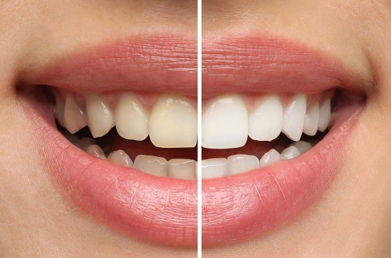 Comment blanchir les dents : astuces naturelles, produits et traitements efficaces