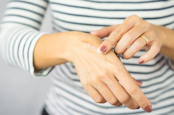 Crema cicatrizante: ¿Cómo escoger la que mejor conviene?
