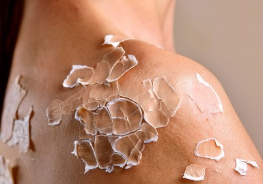 Peau qui pèle : comprendre les causes et solutions pour retrouver une peau saine