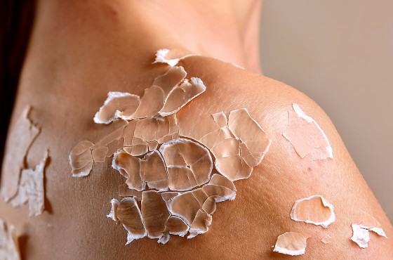 Peau qui pèle : comprendre les causes et solutions pour retrouver une peau saine