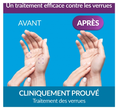 Excilor Verruxit Cryo Traitement des Verrues 50 ml