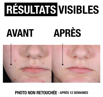 Neutrogena Anti-Boutons + Sérum Quotidien Sans Parfum 30 ml