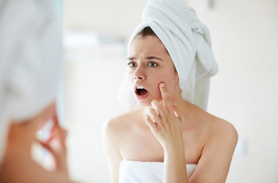 Vencer el acné adaptando tu rutina de belleza ¡es posible!