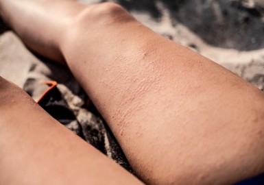 Allergie au Soleil : Comment Prévenir et Soulager les Symptômes