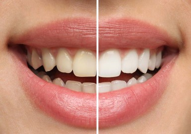 Comment blanchir les dents : astuces naturelles, produits et traitements efficaces