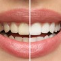 Comment blanchir les dents : astuces naturelles, produits et traitements efficaces