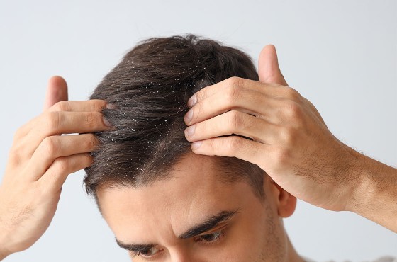 Comprendre et traiter les pellicules des cheveux