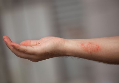 Dartre peau : symptômes, causes et solutions efficaces pour retrouver une peau saine