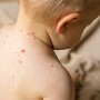 La varicelle chez bébé : comment prévenir les cicatrices ?