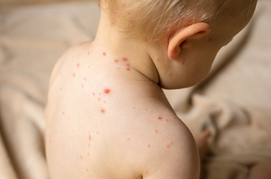 varicelle chez bebe eviter les cicatrices cocooncenter