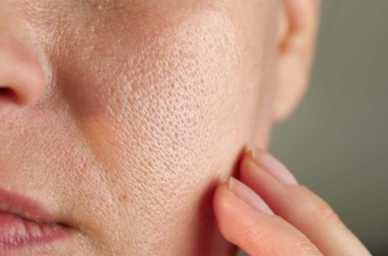 Peau granuleuse : comprendre les causes et retrouver une peau lisse naturellement