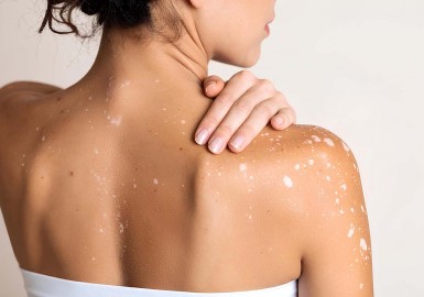 Taches blanches sur la peau : comprendre leurs origines et les solutions efficaces