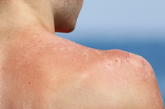 Why and how should you protect yourself from the dangers of the sun?