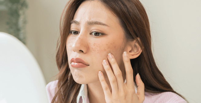 Akne und unreine Haut