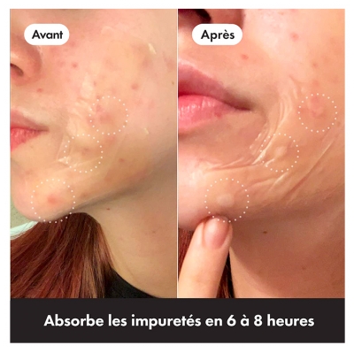 Hero Mighty Patch Surface Patchs Anti-Acné Zones Étendues 10 Patchs Hydrocolloïdes