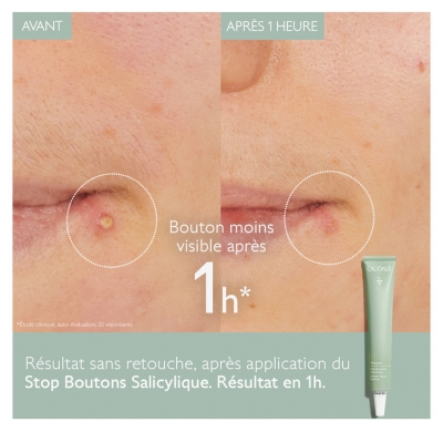 Caudalie Vinopure Krema za ustavljanje mozoljev s salicilno kislino 15 ml