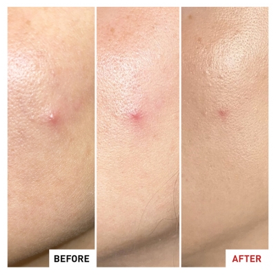 Centella SOS Parche Anti-Imperfecciones 9 ml
