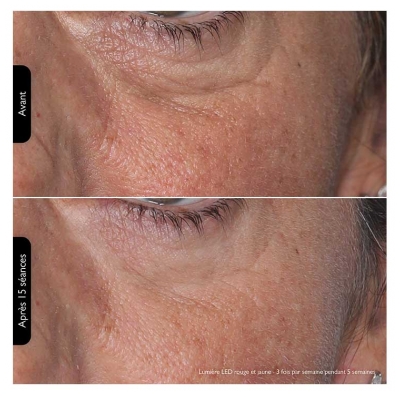 Silk'n Masque Visage LED 100