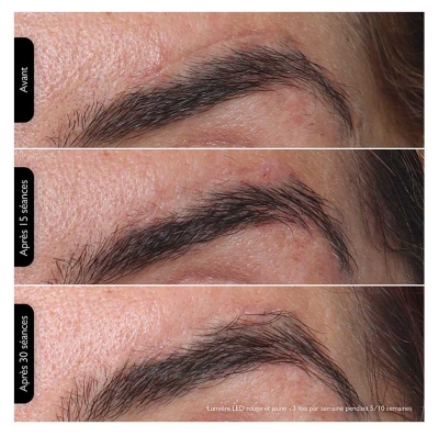 Silk'n Masque Visage LED 100