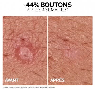 La Roche-Posay Effaclar Duo+M 40 ml